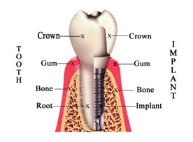 Dental Implants in Peabody, MA